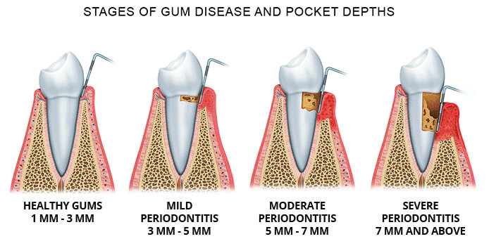 gum disease stages how serious is gum disease south brisbane cp dental