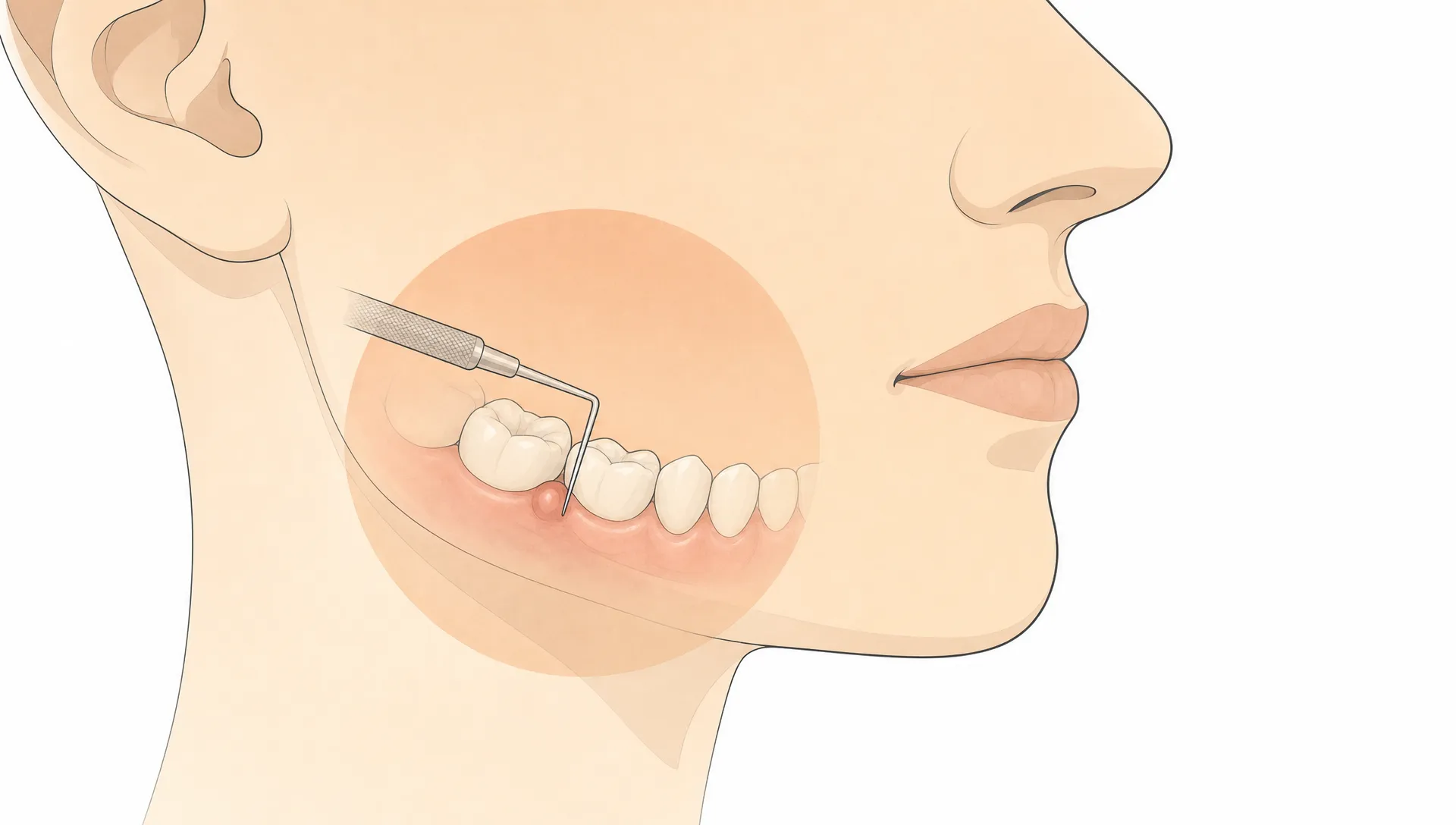 A jaw and back tooth with swelling highlighted during a dental infection check.