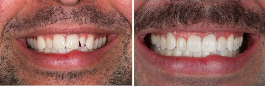 Before and after clear aligner treatment, patient case 1