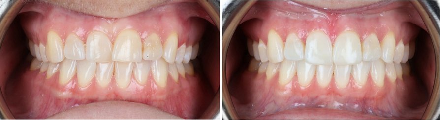 Before and after clear aligner treatment, patient case 2